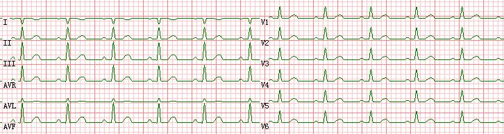 ECG WAVE