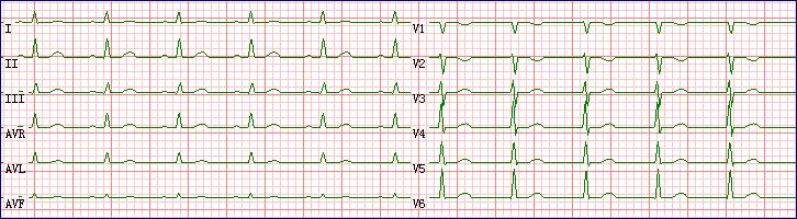 ECG WAVE