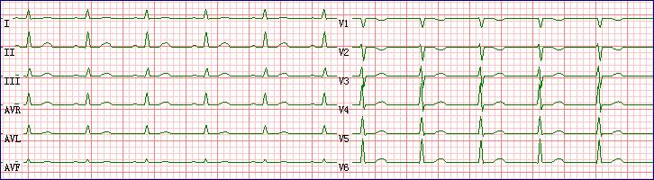 ECG WAVE